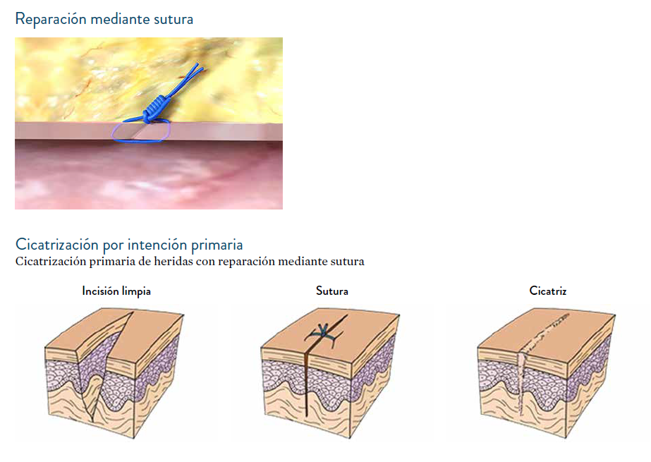 es-reparacion-mediante-sutura-prostyle.PNG