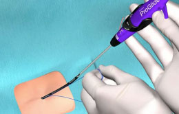 Perclose Perclose Proglide™ For Vascular Closure – CNCRA