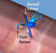 Perclose ProGlide Vascular Closure | Percutaneous Repair